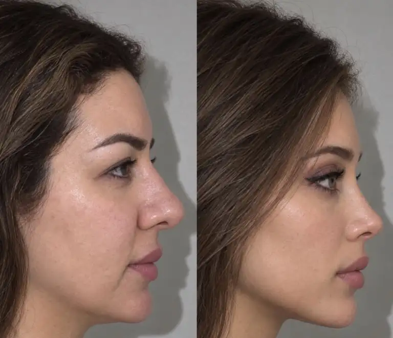 Face in profile before and after masseter Botox