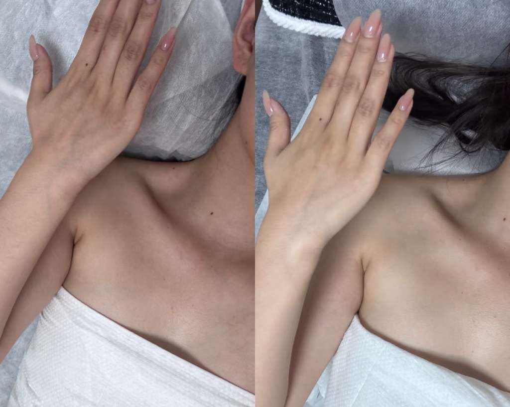 Neck and shoulders before and after trapezius Botox, side by side