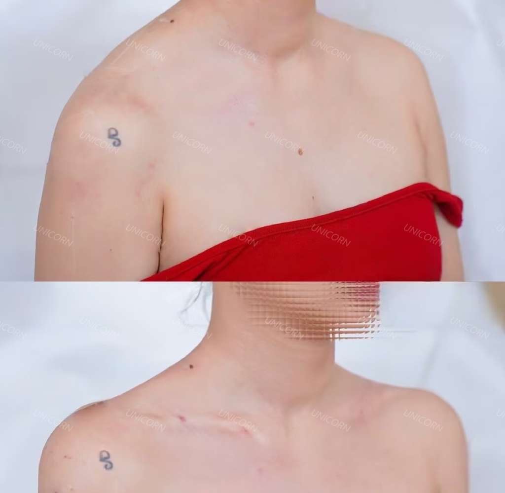 Shoulders before (top) and after (bottom) trapezius Botox
