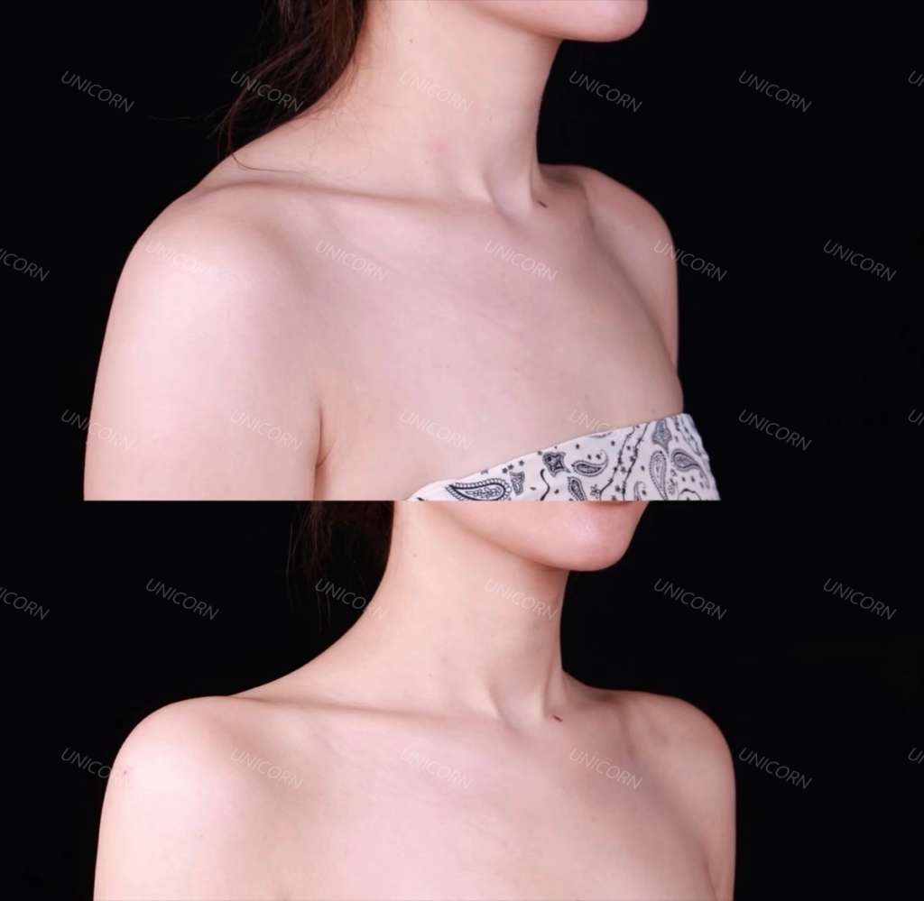 Shoulders before (top) and after (bottom) trapezius Botox